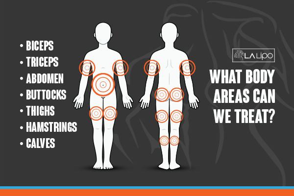 Graphic to show areas you can have LA-EMS Body Sculpting Buckingham treatment.