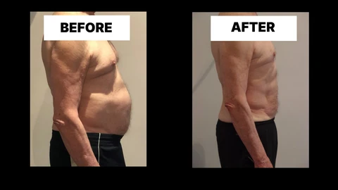 What Symptoms Can Diastasis Recti Cause in Men? Weak Core, Back Pain and Poor Posture Buckingham